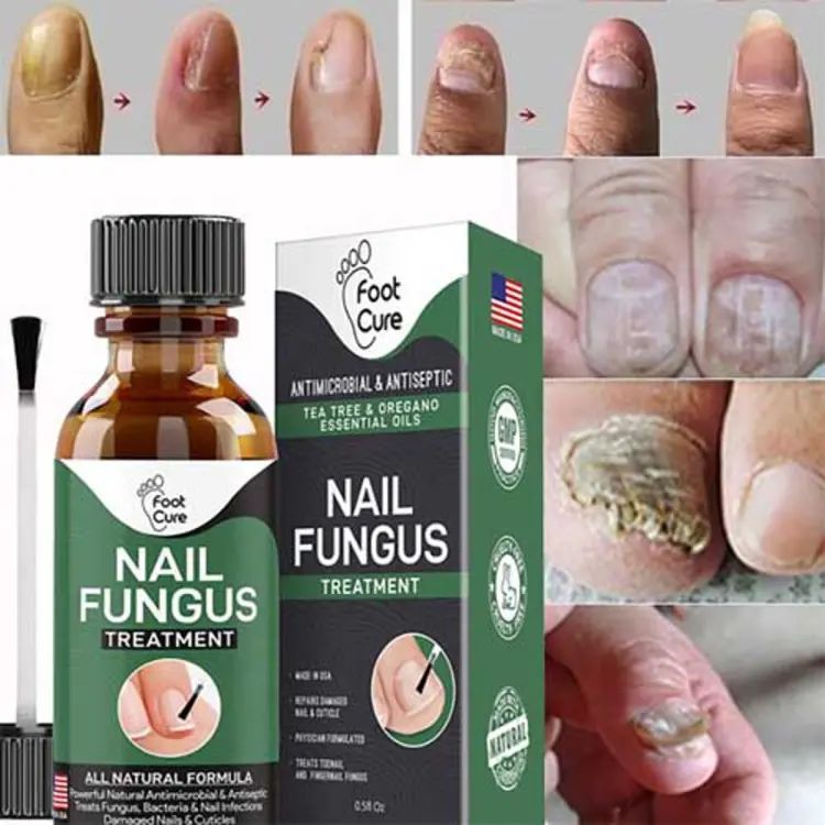 Fingernail Fungus Remover