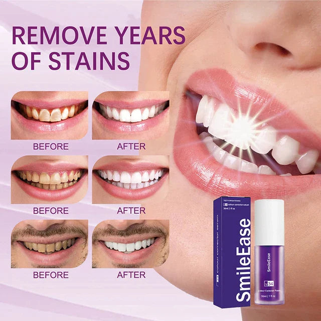 HiSmile Teeth Whitening